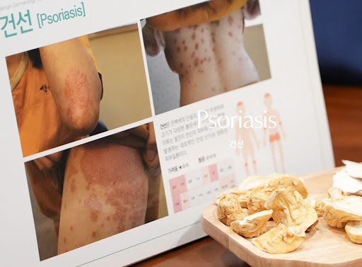 생기한의원 건선 페이지, 피부 변화 지속 시 진료 방향 살펴보기
